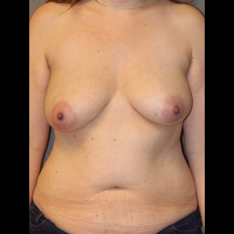 Color photo of chest area: Breast Reconstruction DIEP Flap - Before