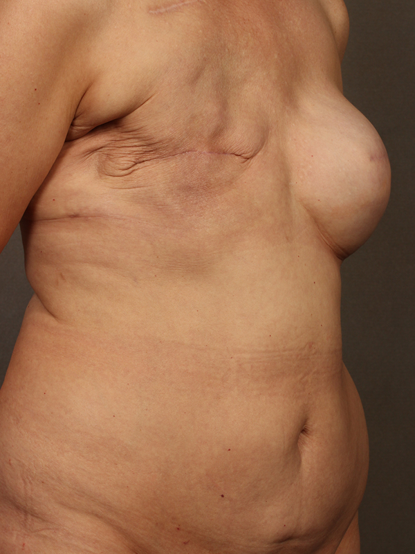 Color photo of woman chest area: Breast Reconstruction Diep Flap Case 17 OTHER SIDE VIEW