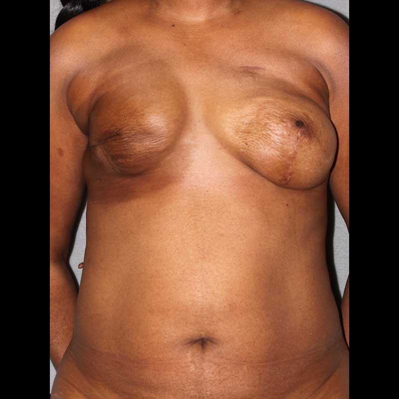 Before photo of chest area: Breast Reconstruction DIEP Flap