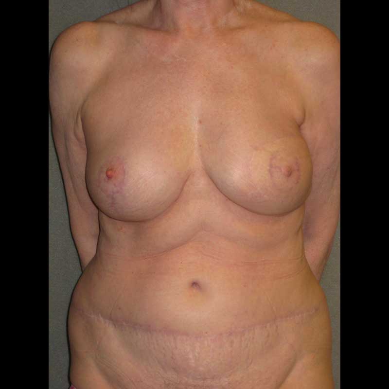 Color photo of chest area: Breast Reconstruction DIEP Flap