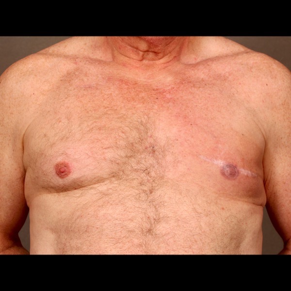 After Photo Case 9: Breast Reconstruction Latissimus Flap