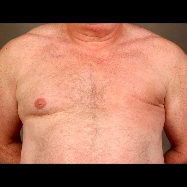 Case 9 Breast Reconstruction Latissimus Flap