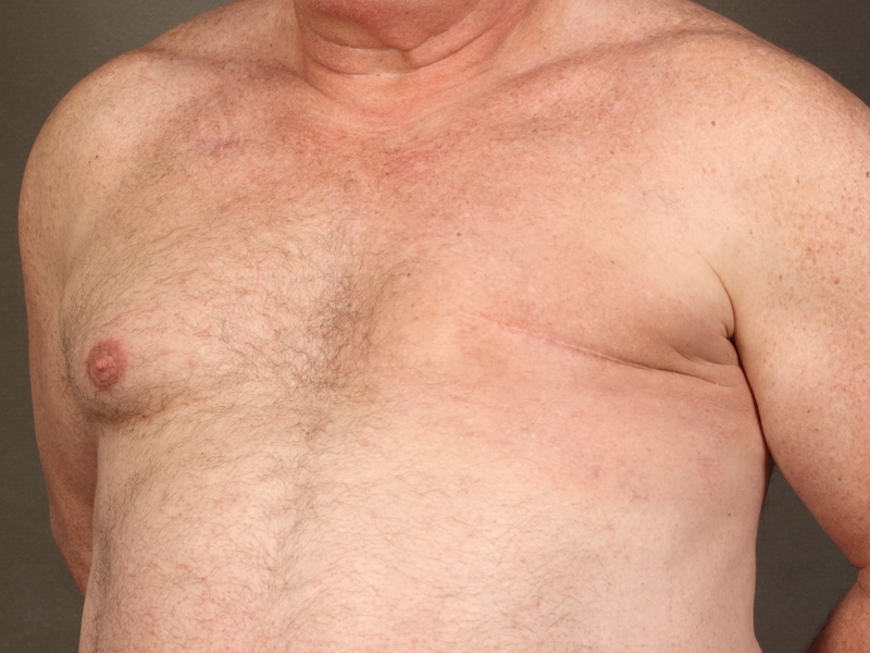 Color photo of chest area: Breast Reconstruction Latissimus Flap