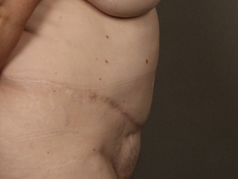Color photo of belly area: Breast Reconstruction TRAM Hernia Repair