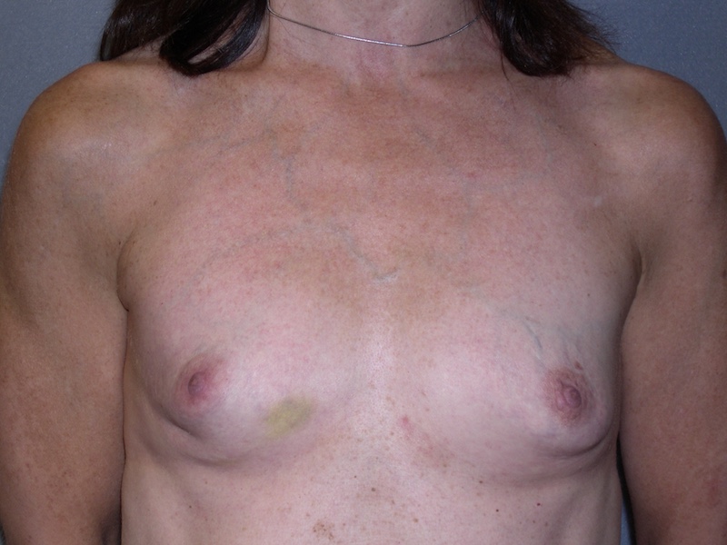 Color photo of chest area: Breast Reconstruction Expander Implant