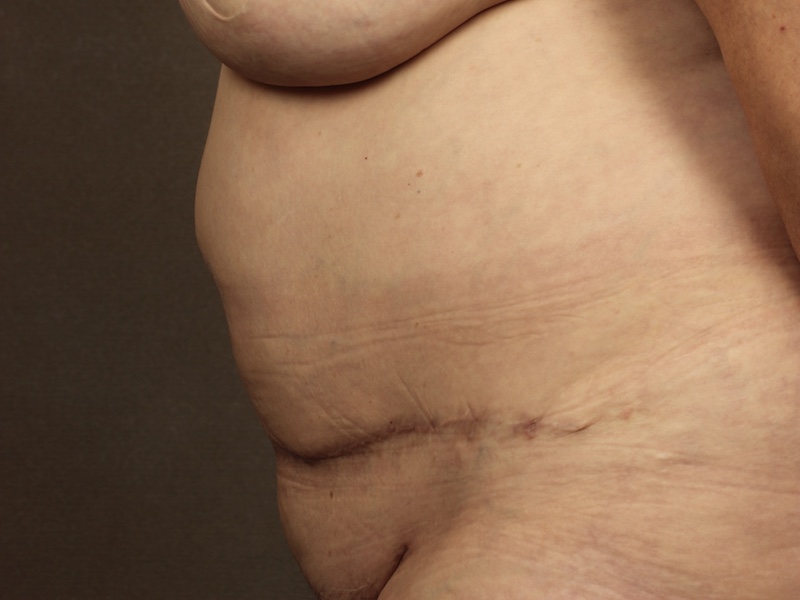 Color photo of belly area: Breast Reconstruction TRAM Hernia Repair - After Alternative 2nd