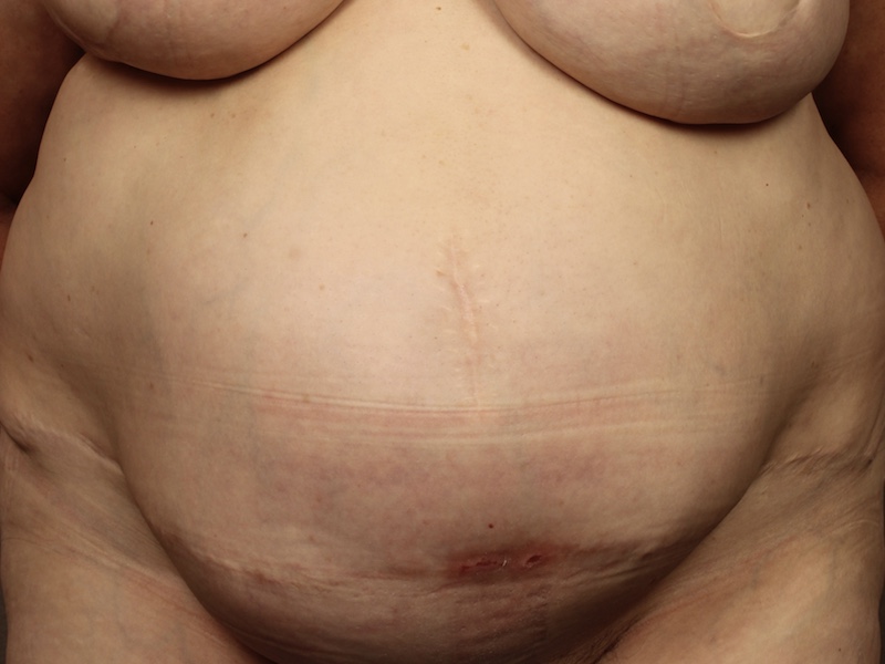 Color photo of belly area: Breast Reconstruction TRAM Hernia Repair - Before Alternative