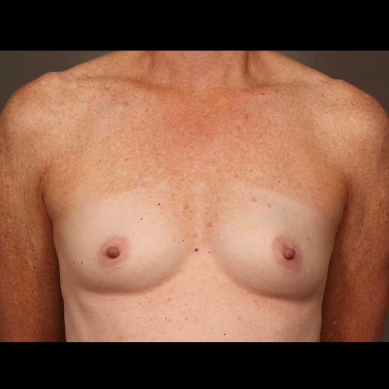 Color photo of chest area: Breast Reconstruction Direct to Implant - Before