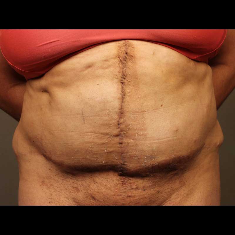 Hernia Repair Belly View