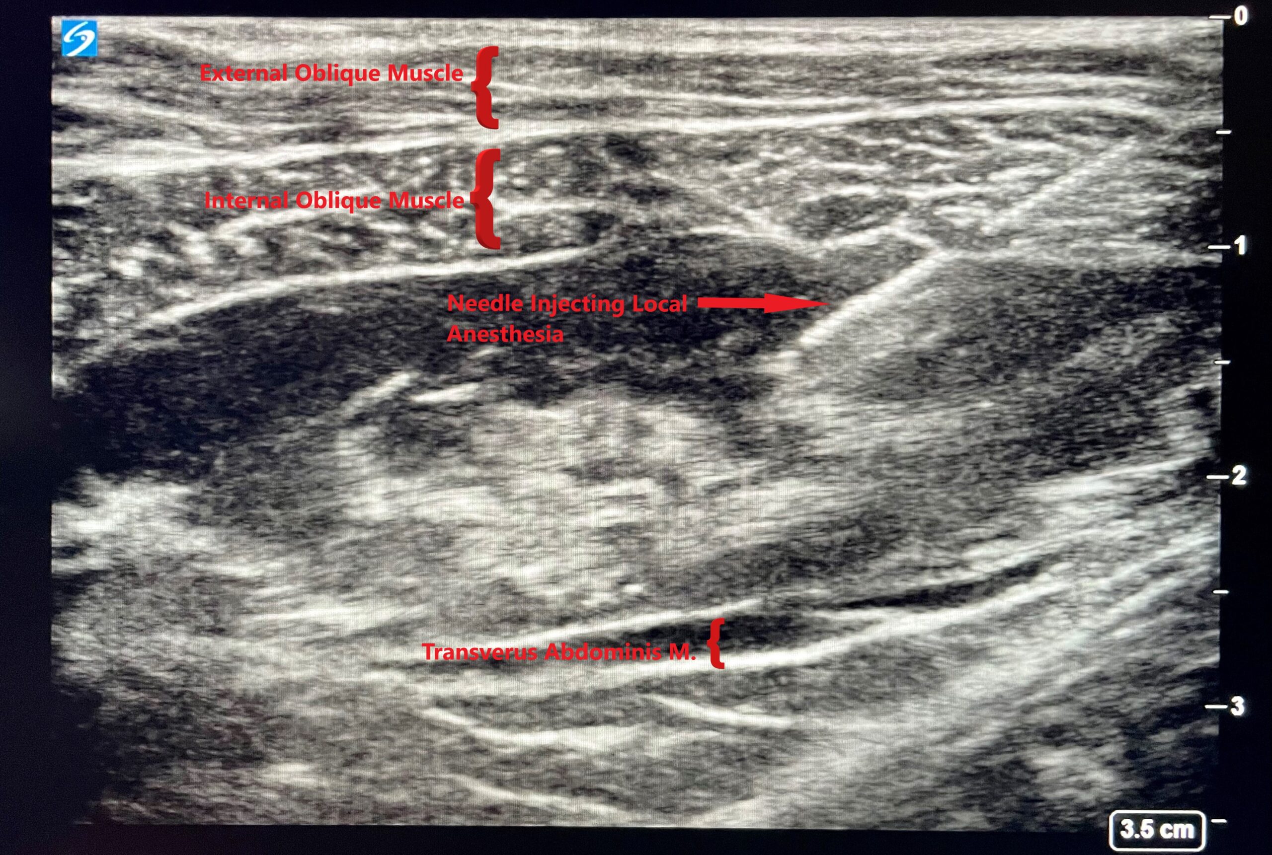 Dr. Light ERAS scan of muscle where anesthesia is injected