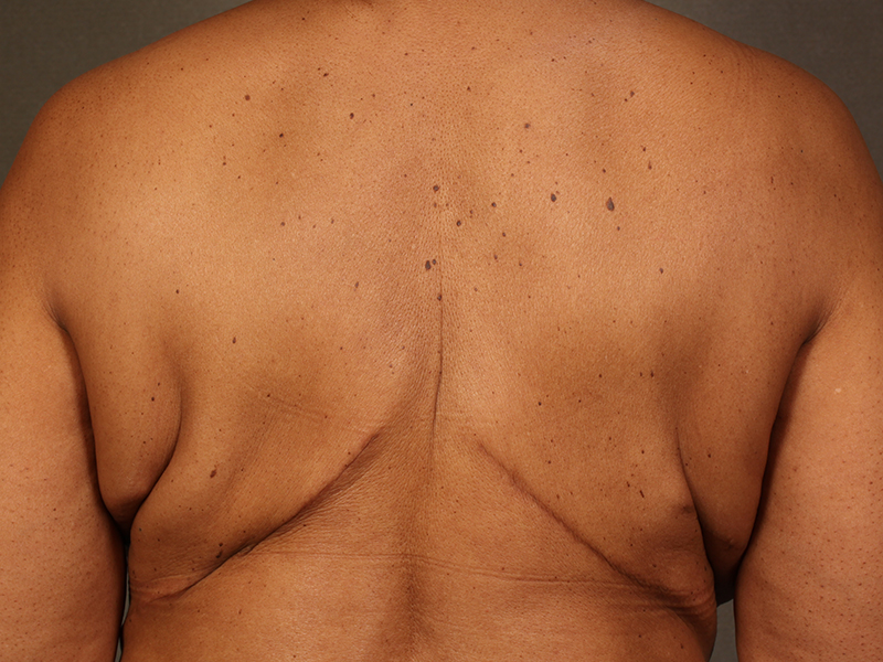 Color photo of back area: Breast Reconstruction Latissimus Flap