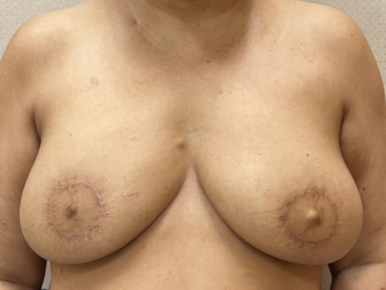 Nipple Tattoo Case 2 (Indira) - Before Alternative