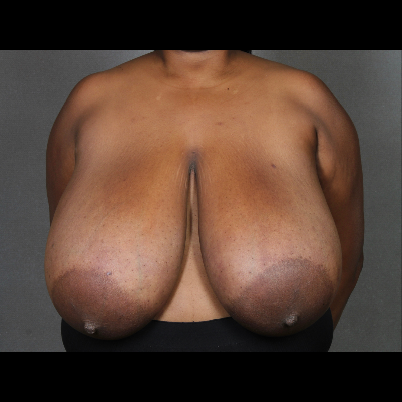 Before Breast Reduction Case 3