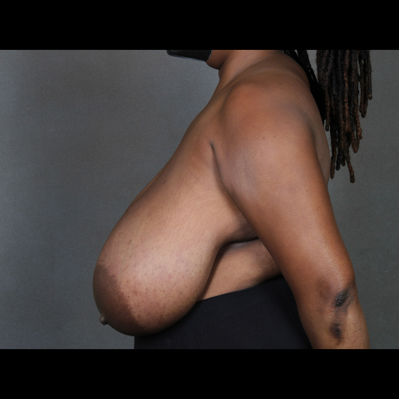Left side Before Breast Reduction Case 3