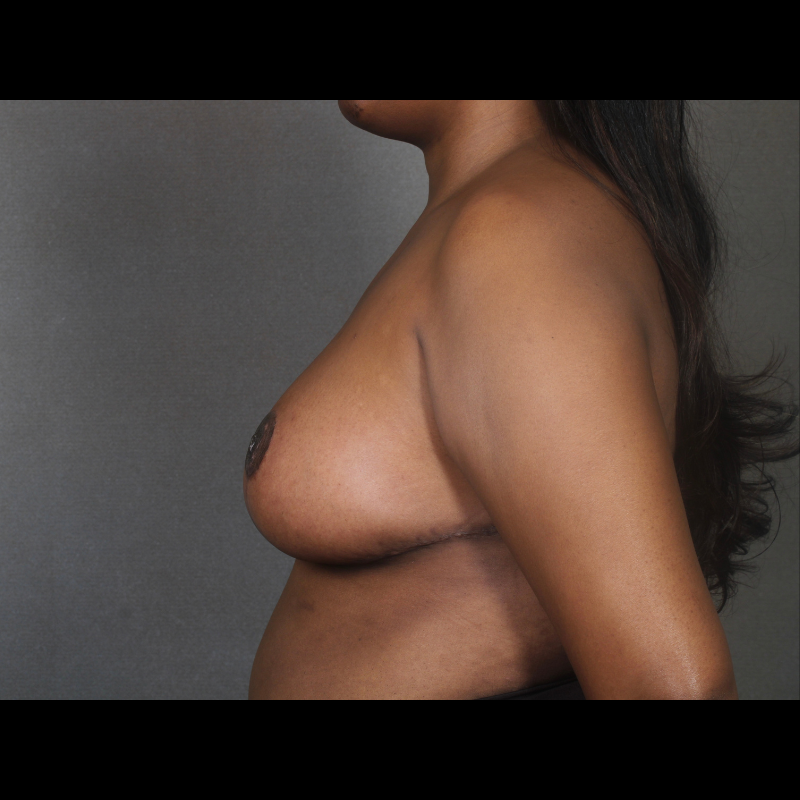 Left side After Breast Reduction Case 3