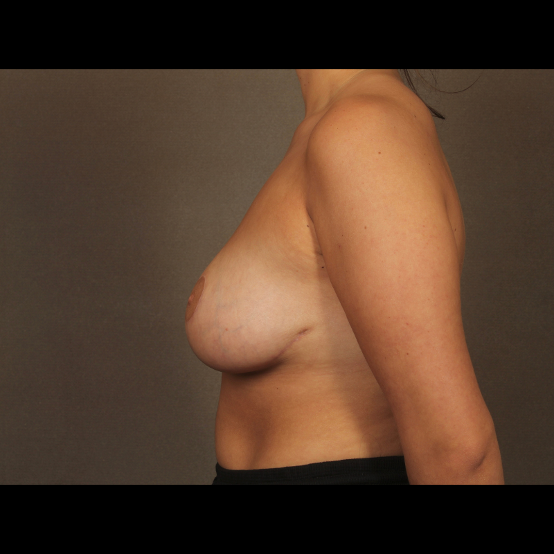 Left side After Breast reduction Case 1
