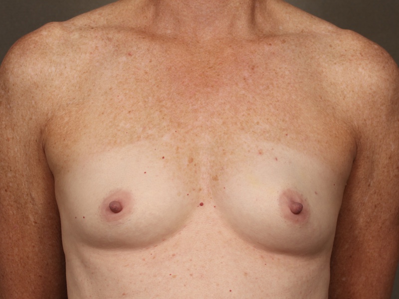 Color photo of chest area: Breast Reconstruction Direct to Implant - Before Alternative