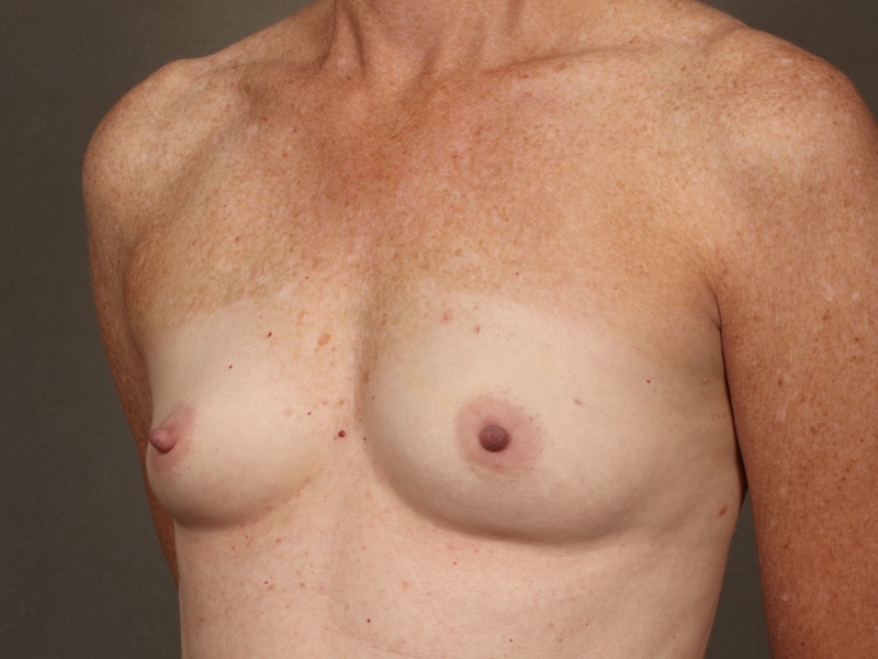 Color photo of chest area: Breast Reconstruction Direct to Implant
