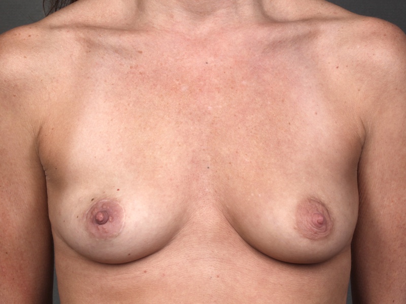 Color photo of chest area: Breast Reconstruction Latissimus Flap
