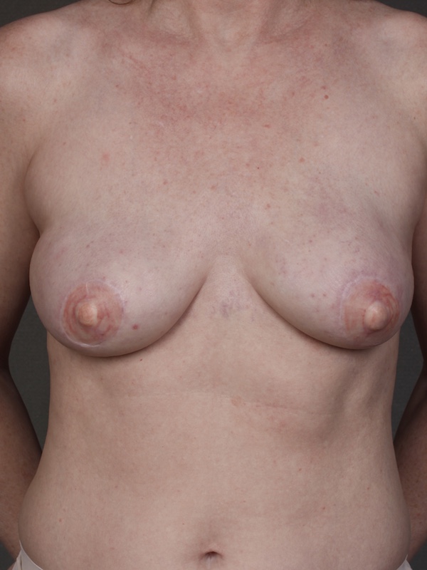 Color photo of chest area: Breast Reconstruction TUG/PAP Flap
