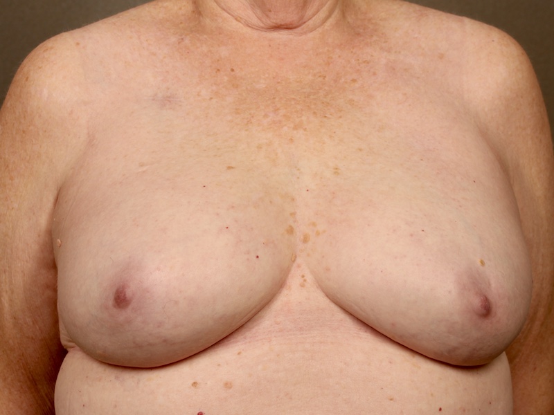 Color photo of chest area: Breast Reconstruction Direct to Implant - After Alternative