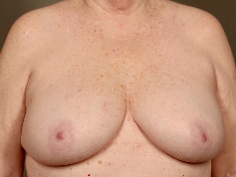 Color photo of chest area: Breast Reconstruction Direct to Implant - Before Alternative