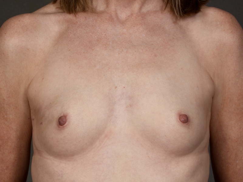 Color photo of chest area: Breast Reconstruction Expander Implant