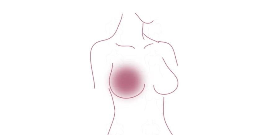 Breast Relief graphic sketch of woman's chest area and pink dot to show the chronic breast pain location