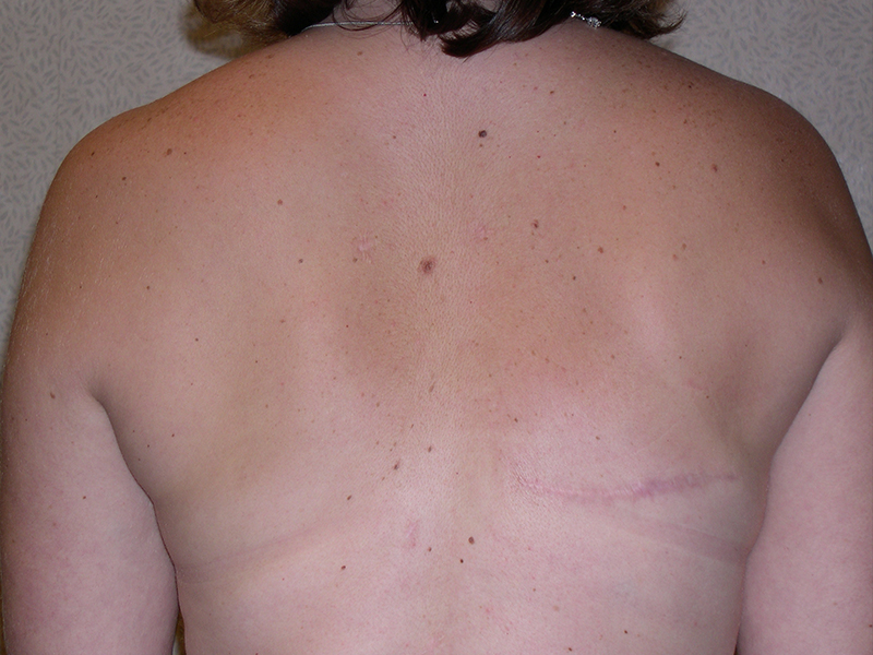 Color photo of back area: Breast Reconstruction Latissimus Flap
