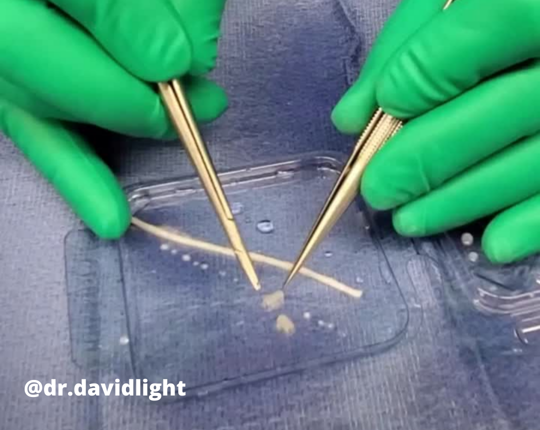 Close up image of gloved hands suturing nerve graft.